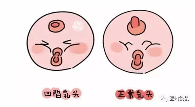 如果乳头完全埋在乳晕下方,根本无法挤出,这就属于重度凹陷,一般需要
