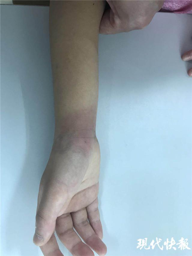 女孩来医院时手腕处红肿接诊医生仔细询问病史,原来,大概 4 天前