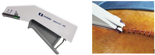 "订书机"的学名是医用皮肤缝合器,在临床使用已经有几十年的历史了,其