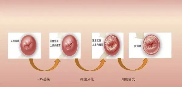 国产双价hpv疫苗首针开打,会改变我们什么?