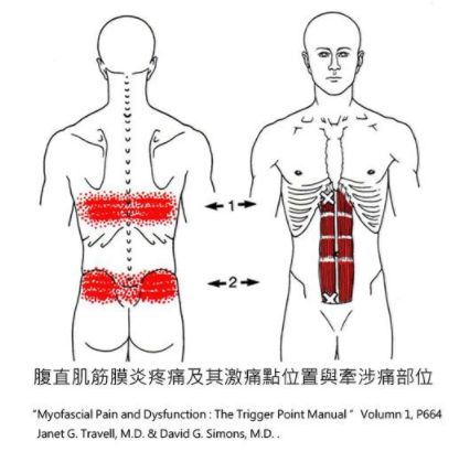 疼痛的症狀直接的外伤和腹部手术的疤痕组织也会产生腹直肌内的激痛点