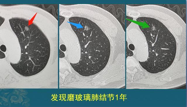 查出肺結節心裡慌看這6個磨玻璃結節病理瞭解手術時機