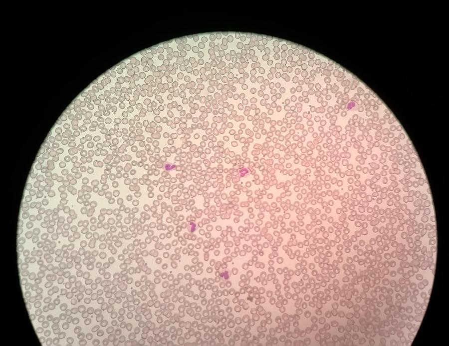 白细胞骤降能不能直接得出检验结果