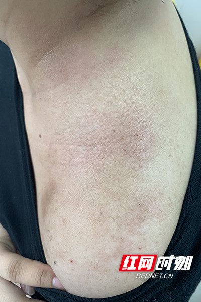陈女士的肩背部长的红疹.