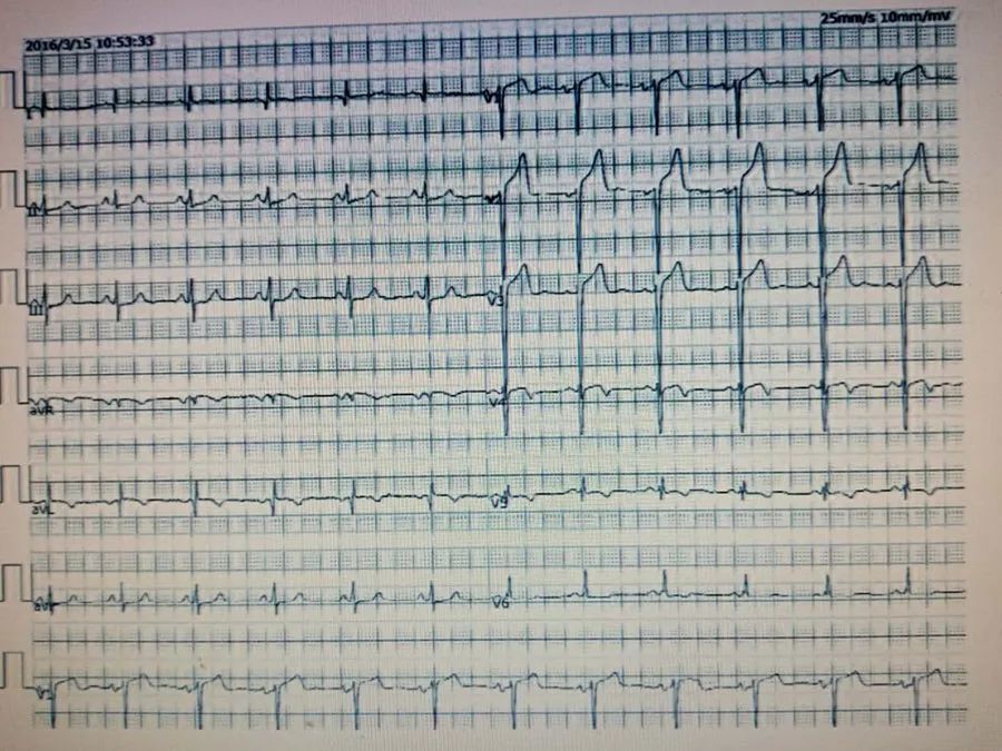 r波递增不良(prwp)分类及心电图特点二r波递增不良是一种