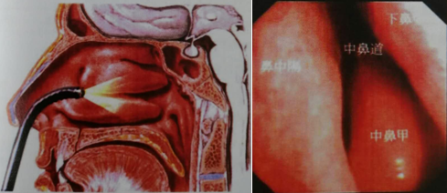 圖25 可彎曲支氣管鏡中鼻道進入鼻後孔示意圖聲門聲門是整個呼吸道最