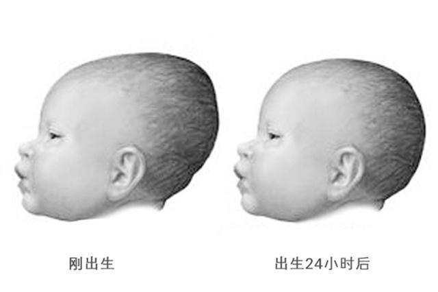 La Fontanelle Du Bebe Est Fermee Trop Tot Ce Qui A Un Impact Sur Le Developpement Du Cerveau Il Y A Trois Situations A Prendre En Compte Nouvelles Du Jour