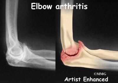 大夫我胳膊肘伸不直了还用不了筷子了我是怎么了啊