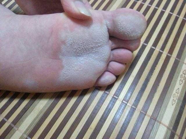 脚臭算是一种病吗散发臭味的原因无非2种看完别再犯