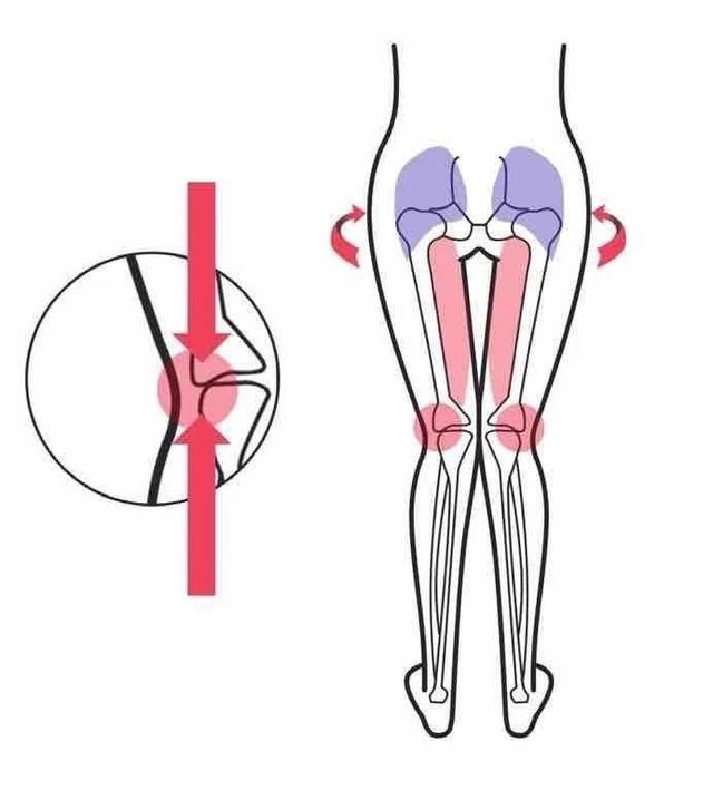 首先要给大家说明今天视频的适用人群:1:双股骨(大腿)内旋2:双小腿内