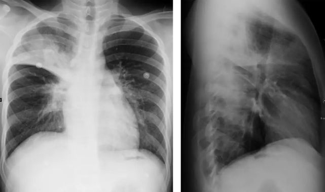 右肺斜裂图片