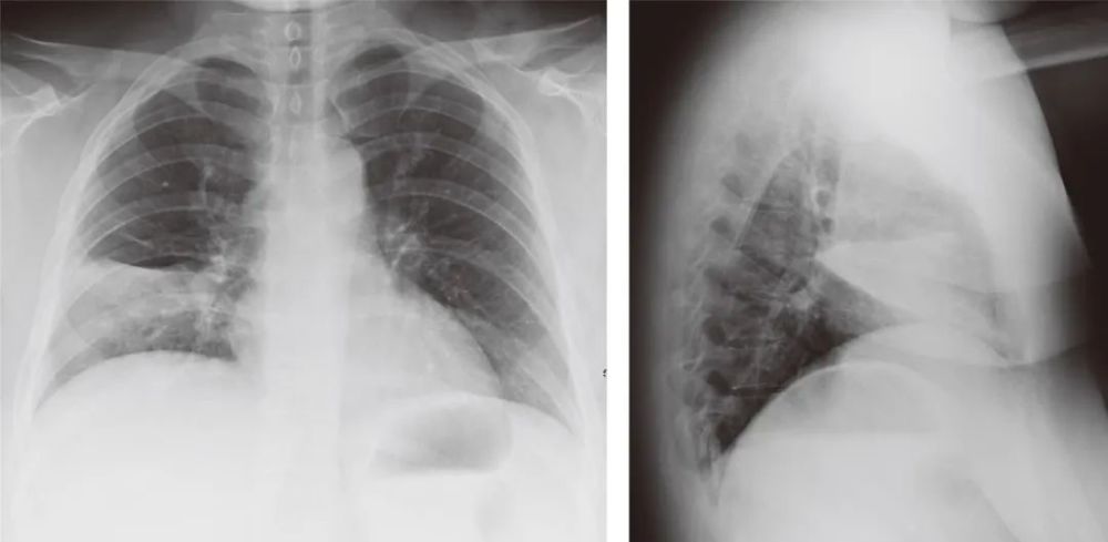 大叶性肺炎x线图片