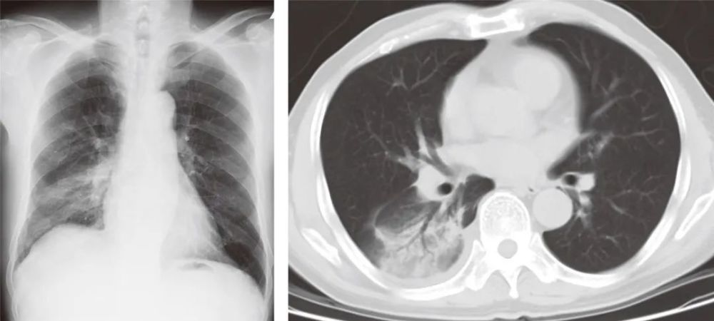右肺斜裂图片