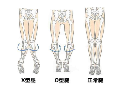 如何正确认识和治疗孩子的八字脚?