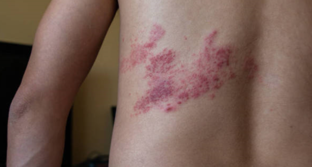 带状疱疹典型的临床表现可有乏力,低热,食欲不振等全身症状,患处皮肤