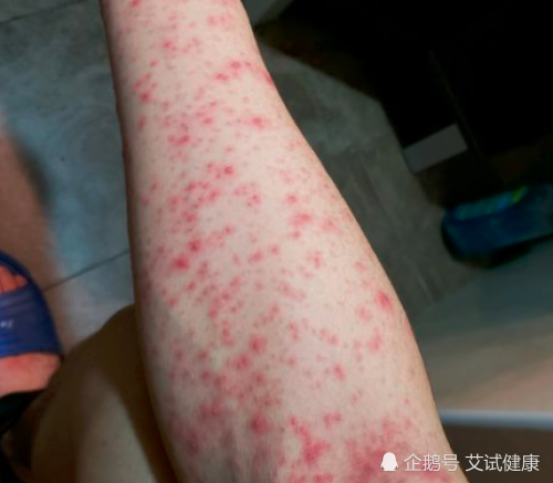 感染后hiv症状的发展过程