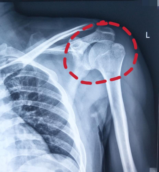 车祸导致肱骨撕脱骨折郑州一市民十余天康复出院为医生送上鲜花