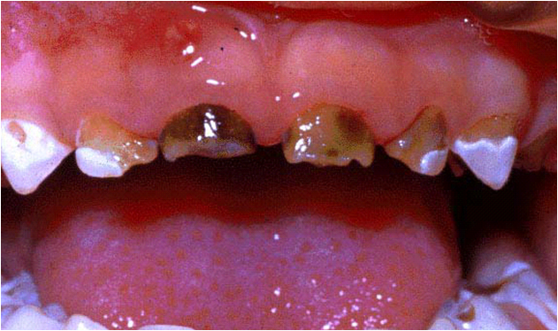 这种蛀牙很棘手新手爸妈一定要当心