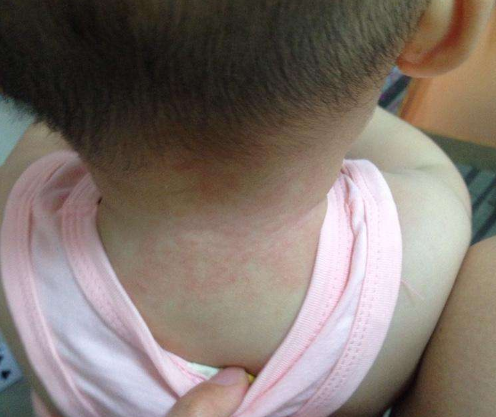 末伏秋老虎坚持3原则避开3误区不让宝宝长最后一茬痱子