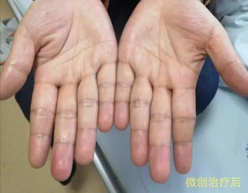 不敢和人握手没法正常用手机因为这双会滴水的手杭州女子自卑20多年