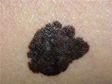 家里有亲属患黑色素瘤,自己患病的风险高吗?