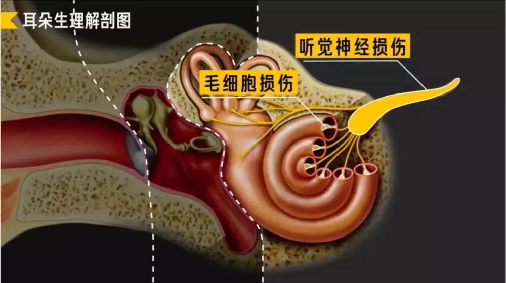 而当内耳出现毛细胞或听觉神经损伤等疾病,就会影响声音的感知,称为感