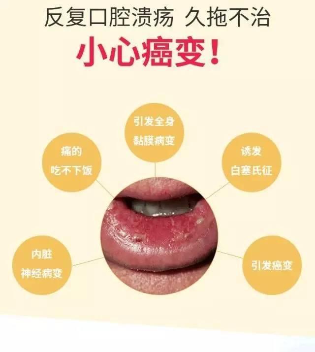 为什么总是发生口腔溃疡?医生告诉您:这样预防和治疗口腔溃疡