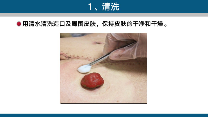 佩戴造口袋操作流程:患者在手術住院期間,造口師就會把造口護理流程