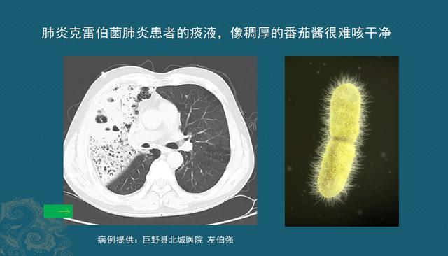 這位肺炎病人就屬於這個情況,毛茸茸的克雷伯菌用菌毛粘住肺部細胞