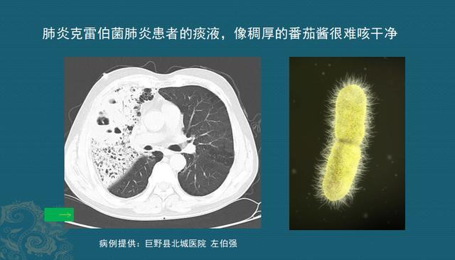 这位肺炎病人就属于这个情况,毛茸茸的克雷伯菌用菌毛粘住肺部细胞