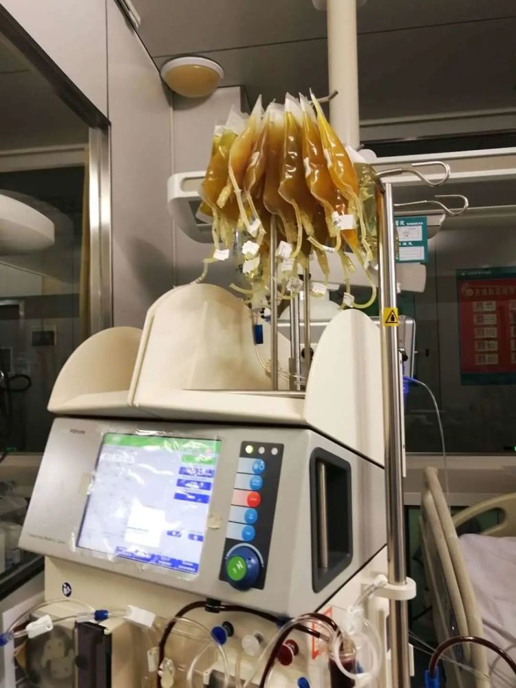 突现罕见病例淄博一女子因头痛就诊全身血浆置换17次