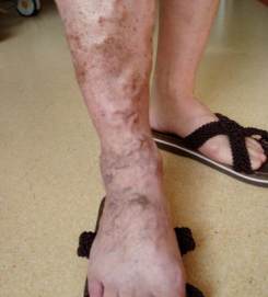 常做一个动作 防治静脉曲张 防血栓 腾讯新闻