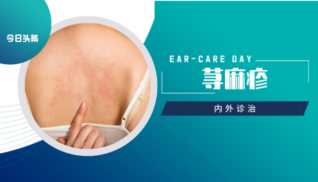 荨麻疹反复 看看内外诊治方法 荨麻疹 中药 消风散