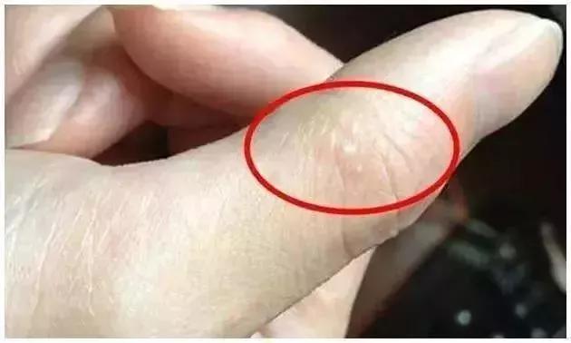 夏天一热,手脚就长小水泡?中医:别以为是上火,可能是湿气重了