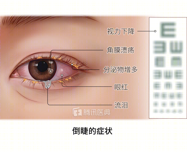 睫毛磨眼睛是因为太长了注意这是眼部疾病出现4种情况要去看医生