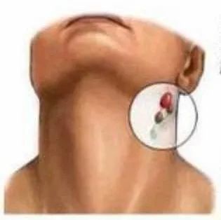 【超声科普】发现颈部淋巴结肿大怎么办?