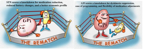 杂志在线发表题为"combined unilateral stn and contralateral gpi