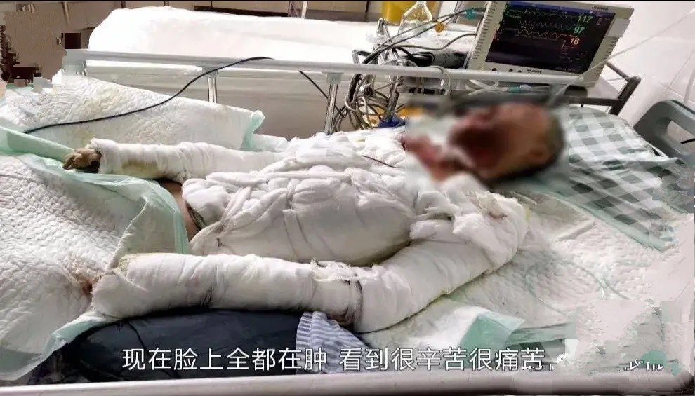 心痛!广东居民楼突发火灾,18岁美女被烧毁容
