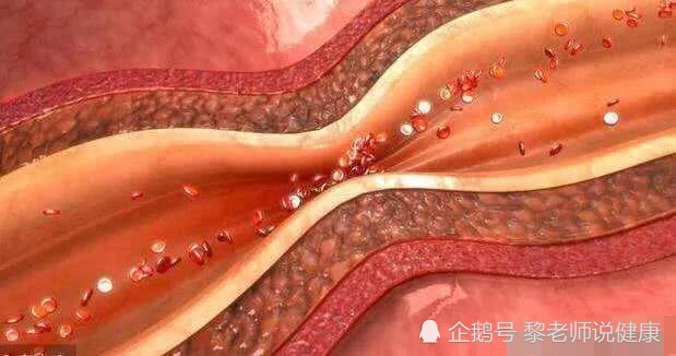 血管变堵时你身体会出现4个异常一个不占说明血管仍通畅