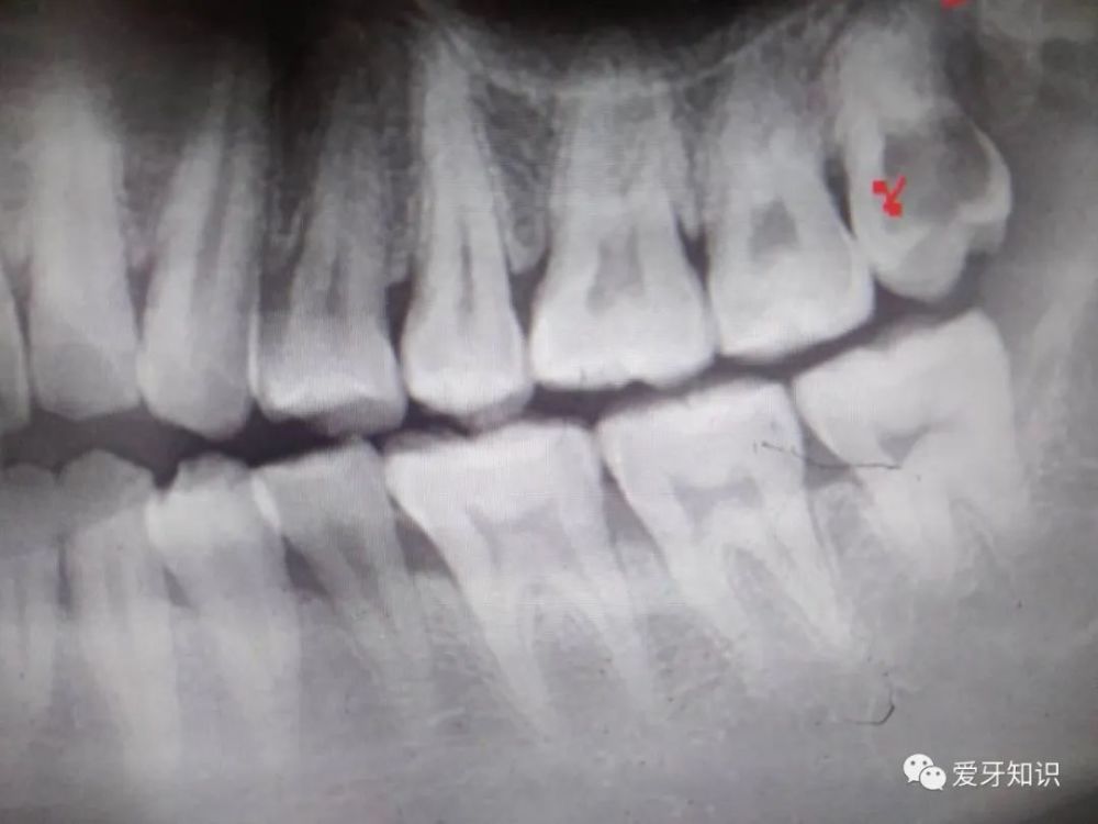 这颗牙齿频繁发炎疼痛 而你还在犹豫拔不拔 腾讯新闻