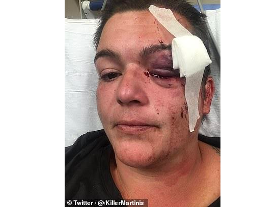美国女记者报道抗议遭警方射爆眼球,一只眼永久失明