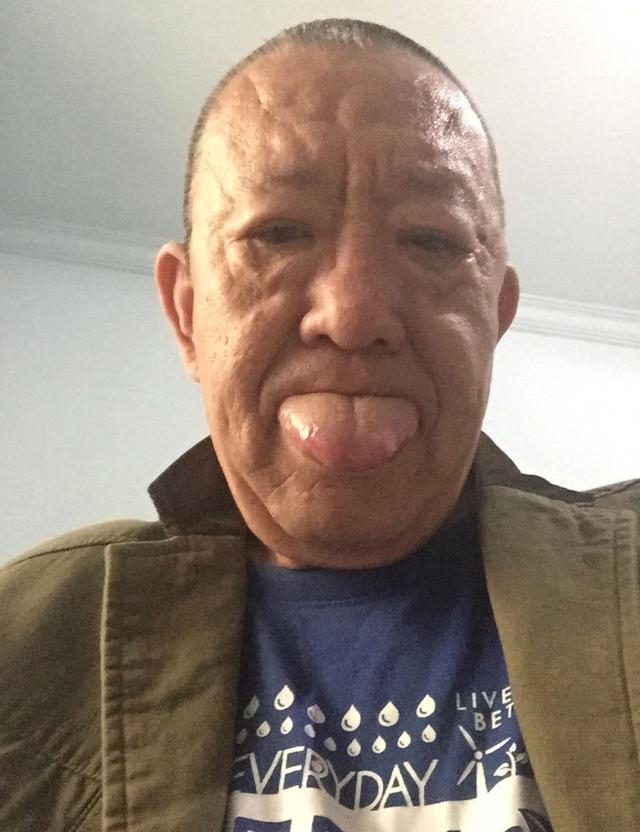 吃饭不小心咬到舌头结果竟导致了舌癌