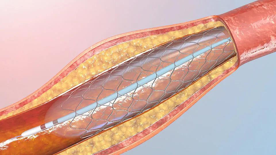 通俗的理解就是,本來患者的血管出現有堵塞的情況,將心臟支架植入患者