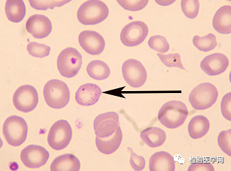 外周血細胞形態學室間質評合輯——紅細胞