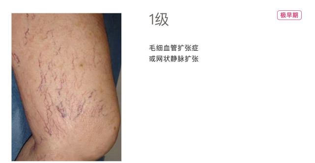 我的静脉曲张严重吗？这6张图简单易懂，教你自己评估，快试试！_腾讯新闻