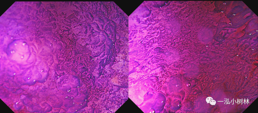 结晶紫染色:大小形态不一圆形pit结构,部分为毁损型pit结构.