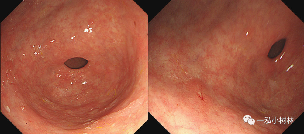白光内镜:胃窦前壁发红iic病变