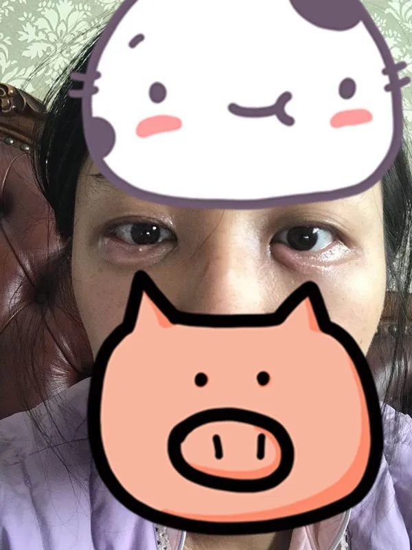 长个麦粒肿而已,怎么最后还要开刀呢?