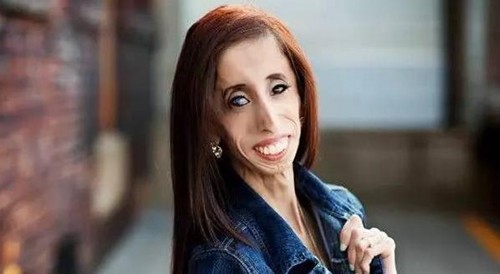 实际上,利兹是因为马凡氏综合征而导致身体看起来要比常人更加瘦小的