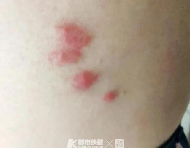 25岁姑娘一觉醒来身上长出红疙瘩 奇痒无比 这和夏天很多人都用的它有关 腾讯新闻